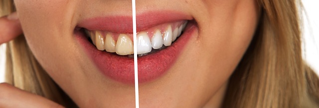 Cómo blanquear tus dientes de forma natural